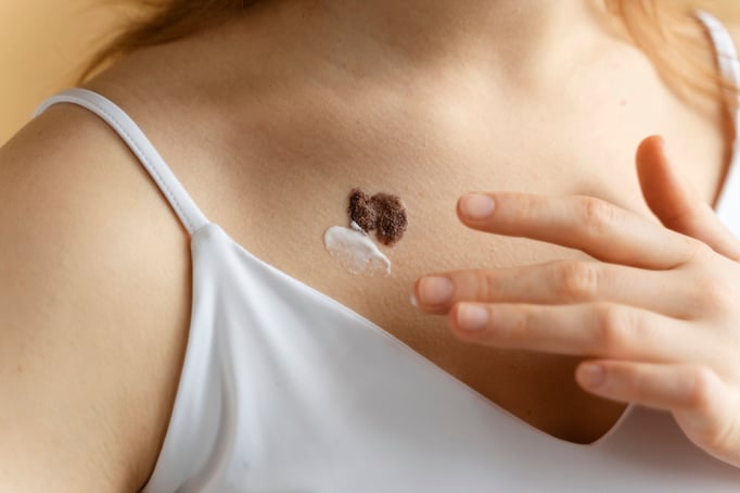 Prevencion cancer de piel